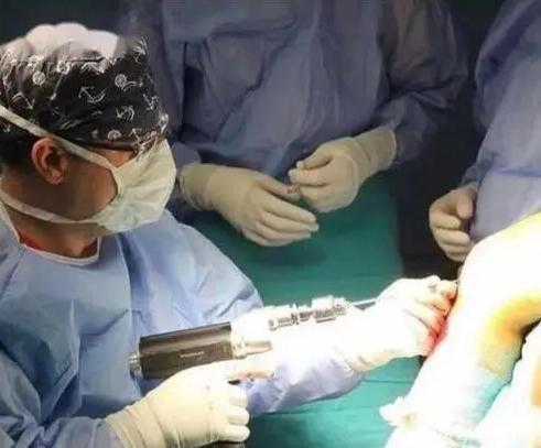 女子出国做断骨增高腿喷脓_女子为了长高，60万出国做断骨增高手术。网友：合法明星早做了